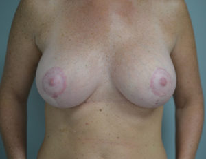 Breast Lift Case 3768 After Photo Breast Lift
