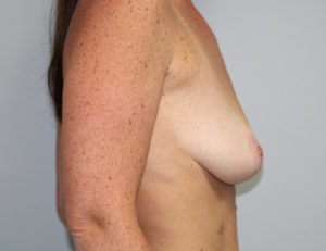 Breast Lift Case 3768 Before Photo Breast Lift