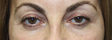 Eyelid Lift Case 3782 Before Photo Eyelid Lift