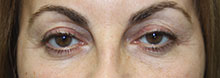 Eyelid Lift