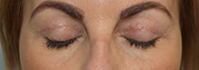 Eyelid Lift Case 3782 After Photo Eyelid Lift