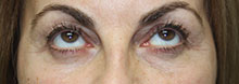 Eyelid Lift Case 3782 Before Photo Eyelid Lift