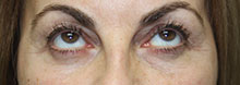 Eyelid Lift