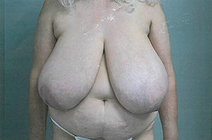 Breast Reduction Case 3822 Before Photo Breast Reduction