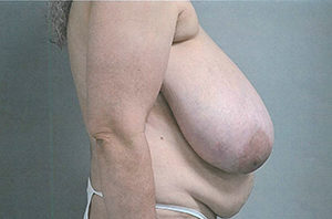Breast Reduction Case 3822 Before Photo Breast Reduction