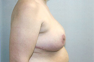 Breast Reduction Case 3822 After Photo Breast Reduction