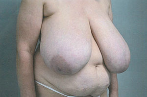 Breast Reduction Case 3822 Before Photo Breast Reduction