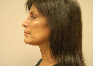 Facelift Case 3801 After Photo Facelift