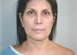 Facelift Case 3801 Before Photo Facelift