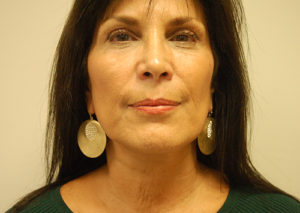 Facelift Case 3801 After Photo Facelift