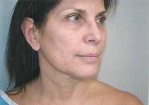 Facelift Case 3801 Before Photo Facelift