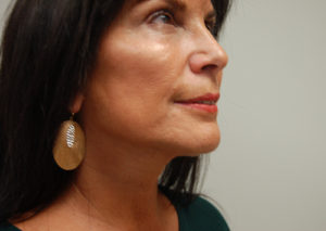 Facelift Case 3801 After Photo Facelift