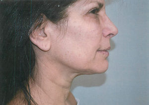 Facelift