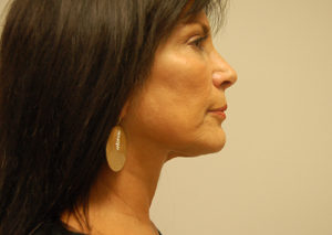 Facelift Case 3801 After Photo Facelift