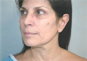 Facelift Case 3801 Before Photo Facelift