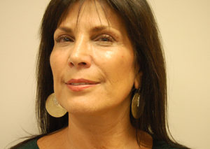 Facelift Case 3801 After Photo Facelift