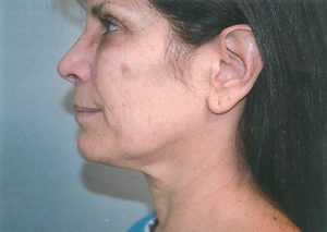 Facelift