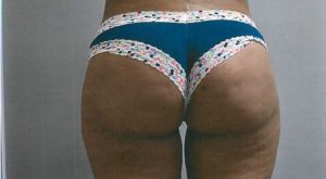 Fat Transfer to Buttock Case 3790 After Photo Fat Transfer to Buttock