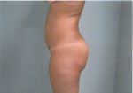 Fat Transfer to Buttock