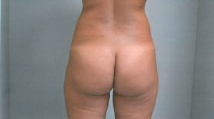 Fat Transfer to Buttock Case 3790 Before Photo Fat Transfer to Buttock