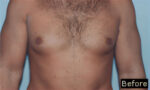 Male Breast Reduction