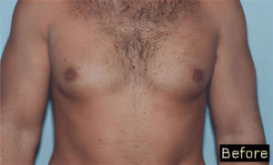 Male Breast Reduction