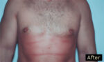 Male Breast Reduction