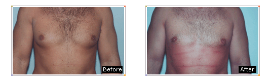 Male Breast Reduction in Fort Worth - Gynecomastia Surgery