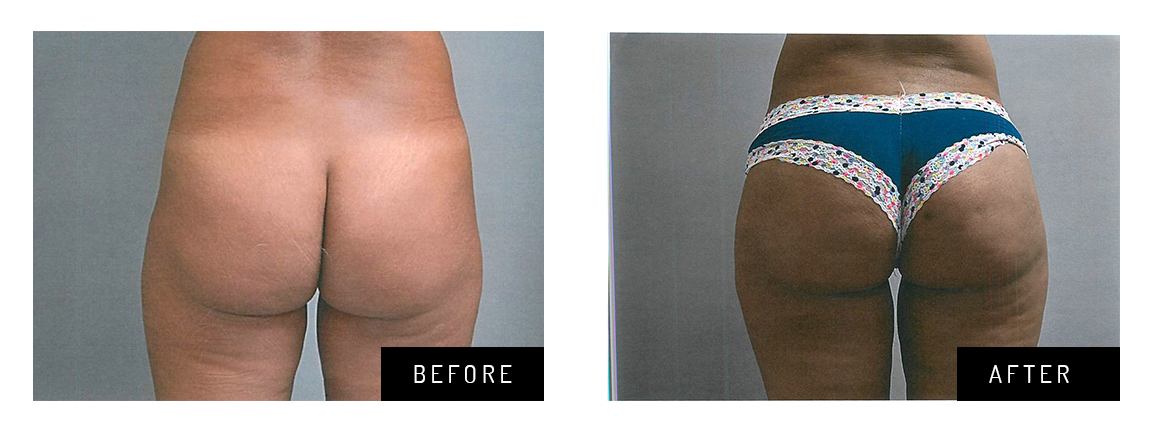 Buttocks Enhancement Before & After Westchester