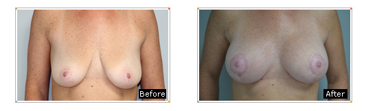 Breast Lift with Implants Results Westchester