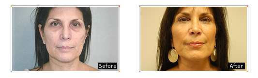 Facelift Results Westchester